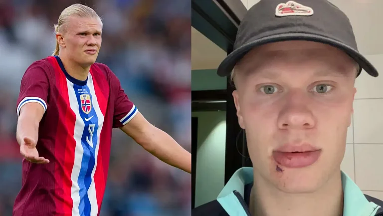 Эрлингу Холанду наложили швы после удара о дверь