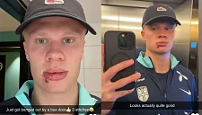 Холанд получил травму лица от двери автобуса